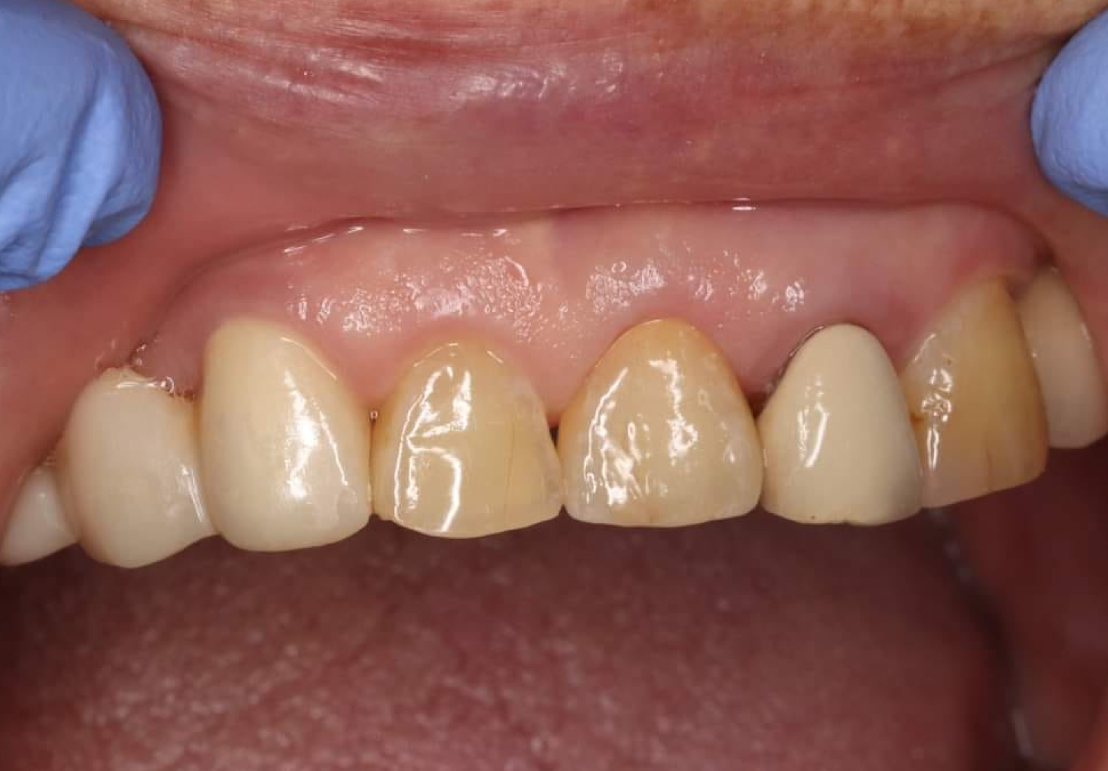 Thin-Layered Ceramic Crown